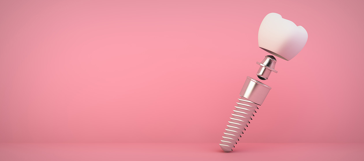dental implants