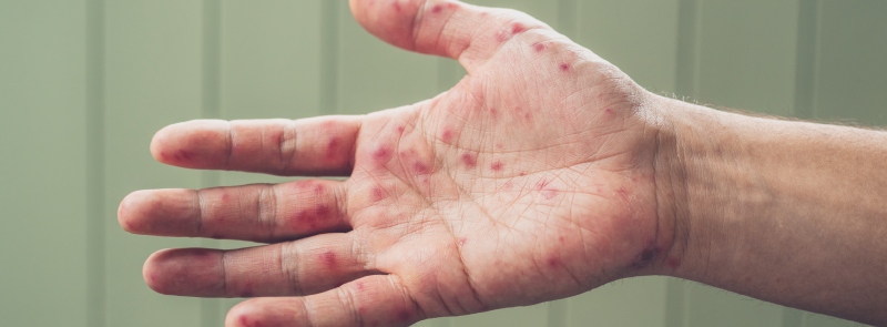 image of hand foot and mouth disease rash