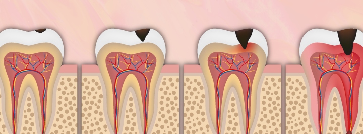 animated tooth decay