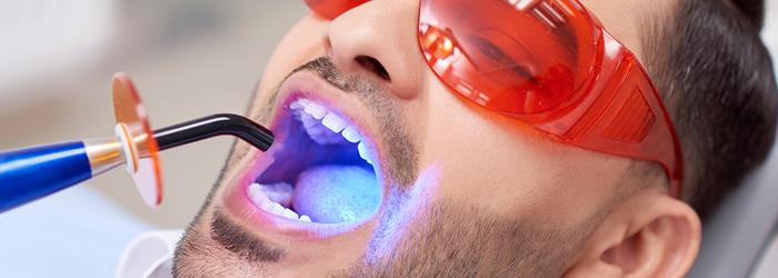 What are dental sealants