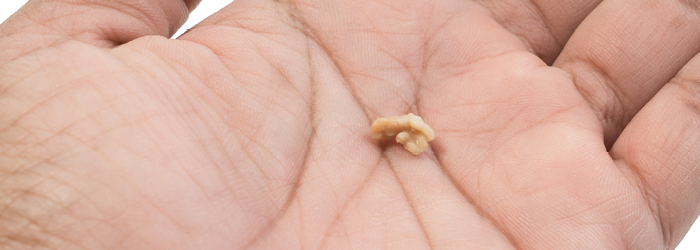 What are tonsil stones