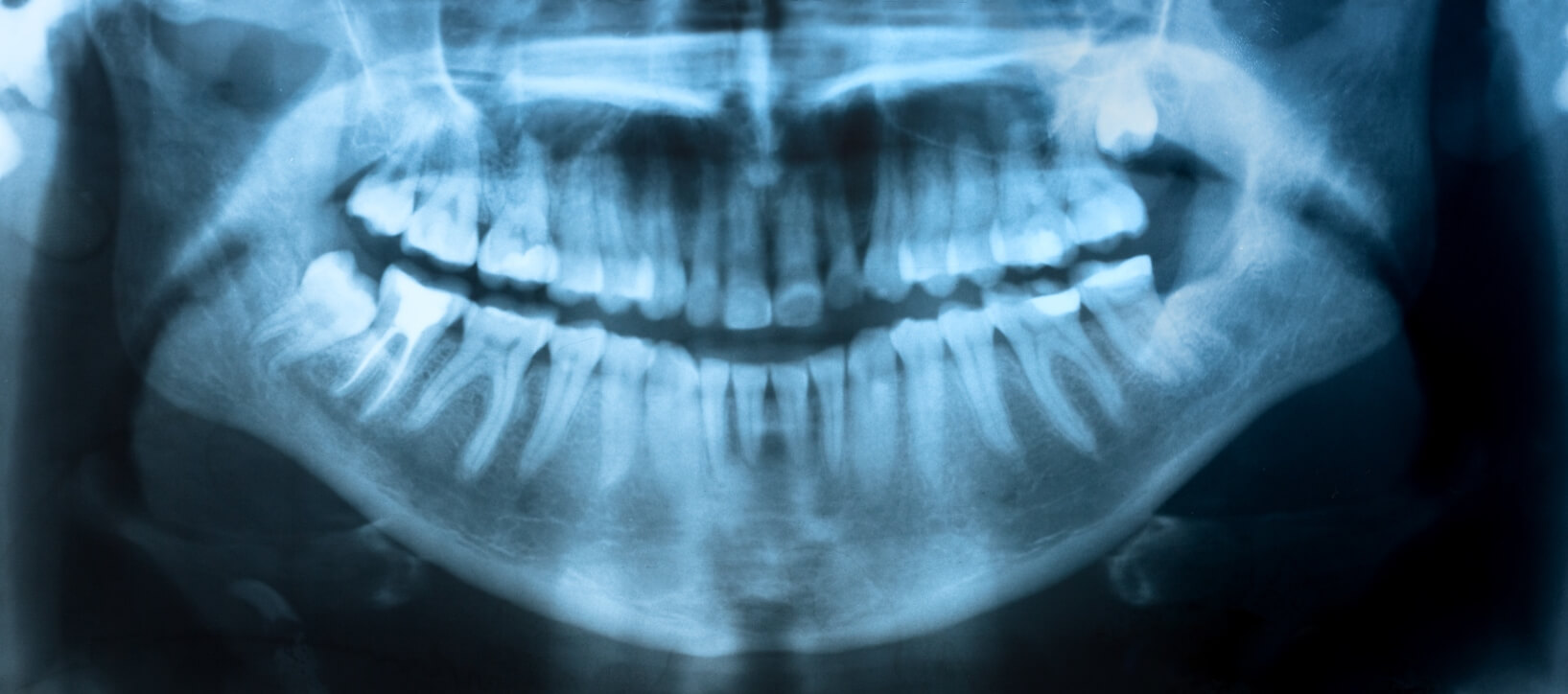 full mouth xray
