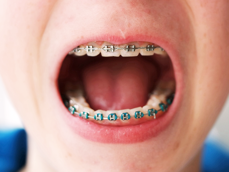 braces delta