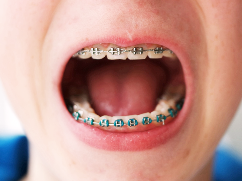 boy with braces opening mouth