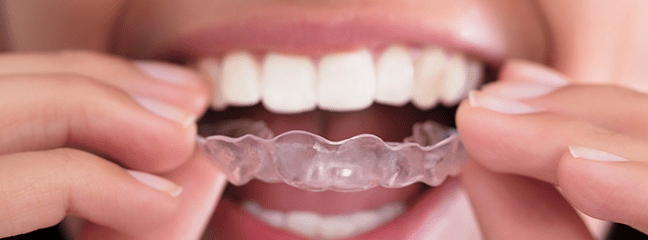 close up of person putting invisalign in